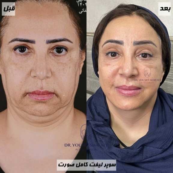 جراح لیفت صورت و گردن در کامرانیه undefined