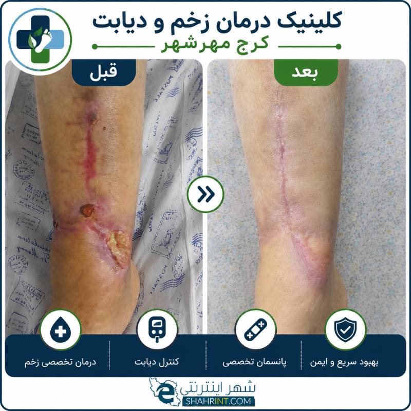 درمانگر زخم مختاری